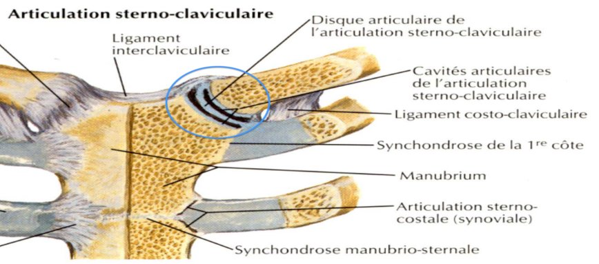 Syndrome de Tietze