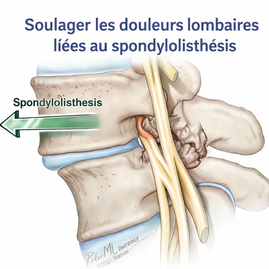 Spondylolisthésis lombaire avec compression nerveuse responsable de lombalgie et sciatique – traitement en ostéopathie à Montpellier